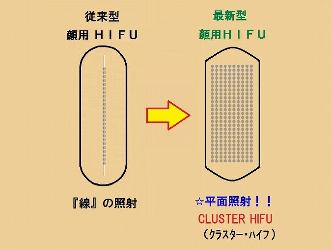クラスターHIFU(ハイフ)