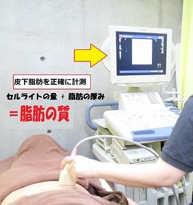 皮下脂肪を正確に計測　セルライトの量＋脂肪の厚み＝脂肪の質