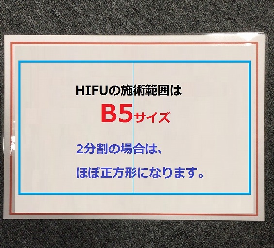 ウルトラHIFUハイフ（高速最新型HIFU）